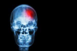 Kentucky Accidents and Traumatic Brain Injuries